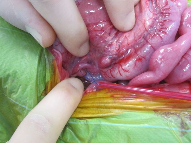 Intraoperative appearance of an extrahepatic PSS 